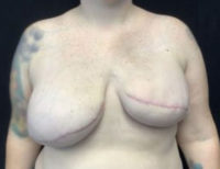 Breast Reconstruction