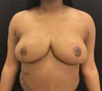 Breast Reduction