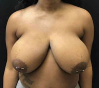 Breast Reduction