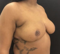 Breast Reduction