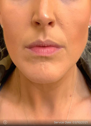 Lip Augmentation