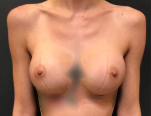 Breast Augmentation