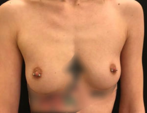 Breast Augmentation