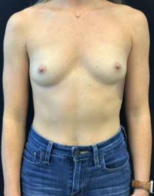 Breast Augmentation