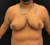Breast Reduction