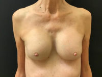 Breast Implant Removal