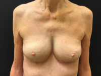 Breast Implant Removal