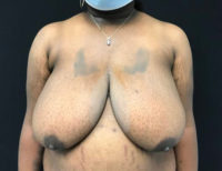 Breast Reduction