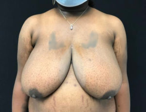 Breast Reduction