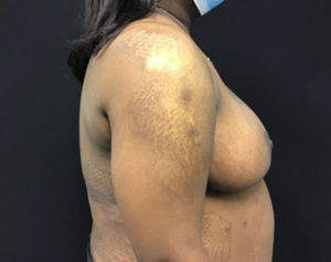 Breast Reduction