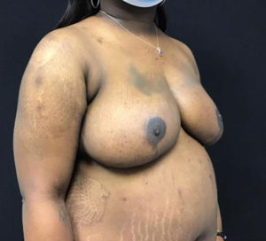 Breast Reduction