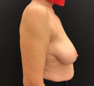 Breast Reduction
