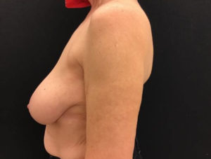 Breast Reduction