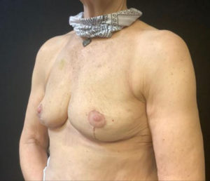 Breast Reduction