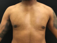 Gynecomastia