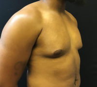 Gynecomastia