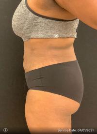 Liposuction