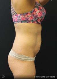 Tummy Tuck