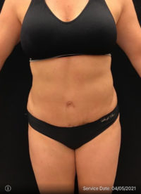 Tummy Tuck