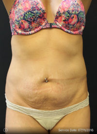 Tummy Tuck