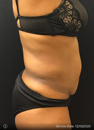 Tummy Tuck