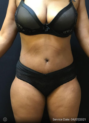 Tummy Tuck