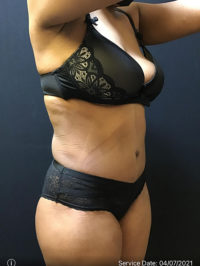 Tummy Tuck