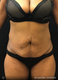 Tummy Tuck