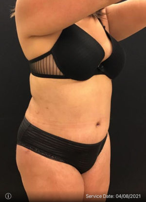 Tummy Tuck