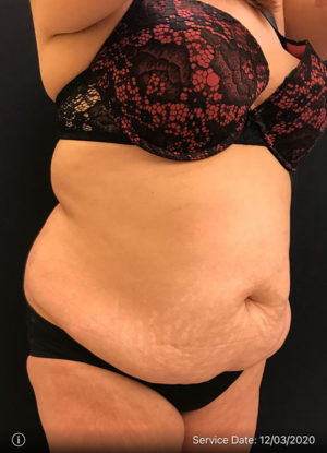 Tummy Tuck