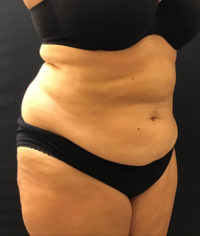 Tummy Tuck