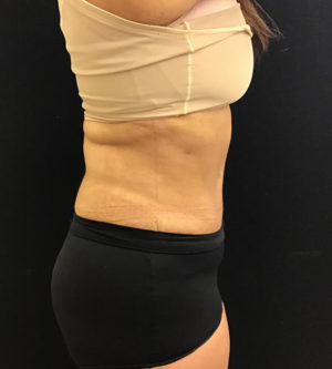 Tummy Tuck