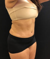 Tummy Tuck