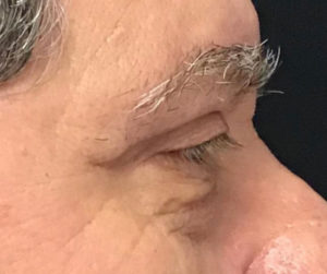 Eyelid Surgery