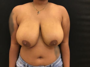 Breast Reduction