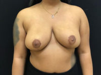 Breast Reduction