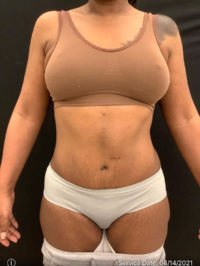 Tummy Tuck