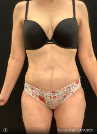 Tummy Tuck