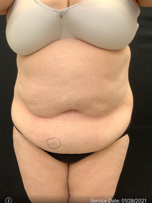 BodyTite