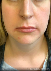 Lip Augmentation