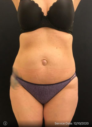 Liposuction