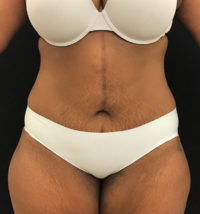 Tummy Tuck