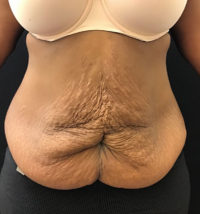 Tummy Tuck