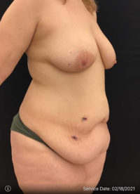 Tummy Tuck