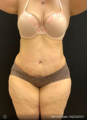 Tummy Tuck