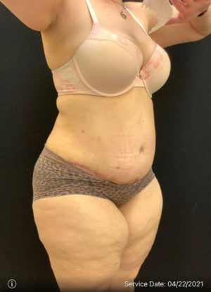 Tummy Tuck