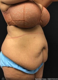 Tummy Tuck