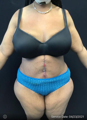 Tummy Tuck