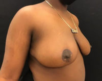 Breast Reduction