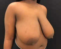 Breast Reduction